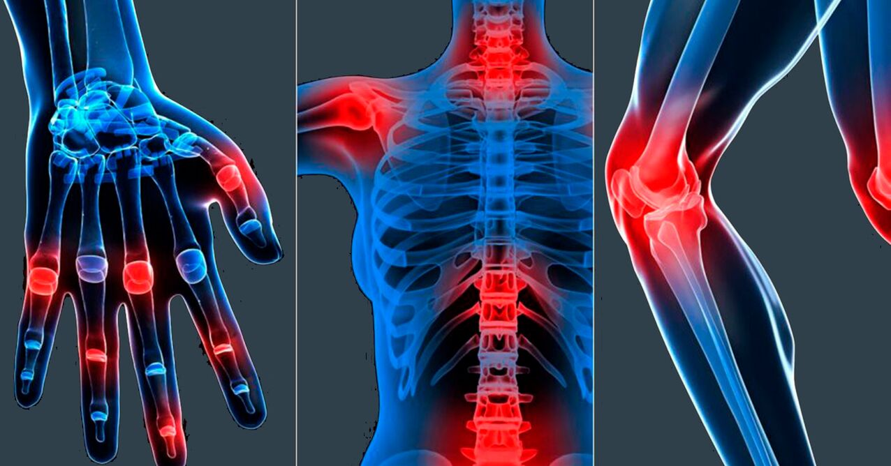 Indikatiounen fir d'Benotzung vum Boswellia Extrakt a Kapselen